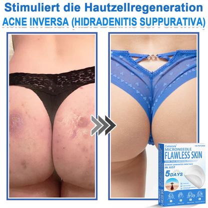 ✅ Celsiora® 2-in-1 Mikronadel- & Hydrokolloid-Pflaster | Entferner für erhabene Muttermale, Akne, flache Warzen & Hautanhängsel | Verbessert Falten, Narben & Hautunreinheiten | Unsichtbare Stern-Pickelpflaster für Gesicht & Körper