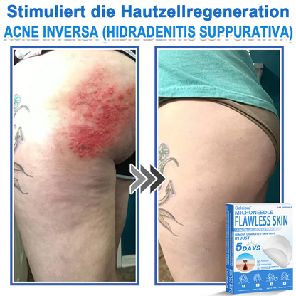 ✅ Celsiora® 2-in-1 Mikronadel- & Hydrokolloid-Pflaster | Entferner für erhabene Muttermale, Akne, flache Warzen & Hautanhängsel | Verbessert Falten, Narben & Hautunreinheiten | Unsichtbare Stern-Pickelpflaster für Gesicht & Körper