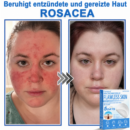 ✅ Celsiora® 2-in-1 Mikronadel- & Hydrokolloid-Pflaster | Entferner für erhabene Muttermale, Akne, flache Warzen & Hautanhängsel | Verbessert Falten, Narben & Hautunreinheiten | Unsichtbare Stern-Pickelpflaster für Gesicht & Körper