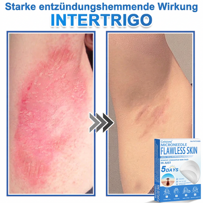 ✅ Celsiora® 2-in-1 Mikronadel- & Hydrokolloid-Pflaster | Entferner für erhabene Muttermale, Akne, flache Warzen & Hautanhängsel | Verbessert Falten, Narben & Hautunreinheiten | Unsichtbare Stern-Pickelpflaster für Gesicht & Körper
