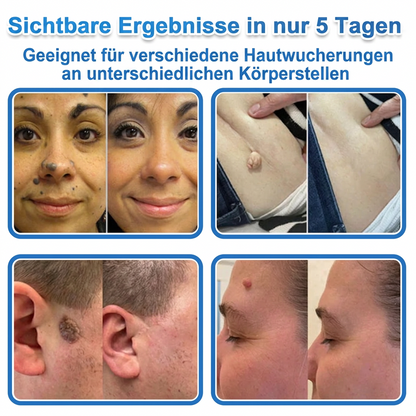 ✅ Celsiora® 2-in-1 Mikronadel- & Hydrokolloid-Pflaster | Entferner für erhabene Muttermale, Akne, flache Warzen & Hautanhängsel | Verbessert Falten, Narben & Hautunreinheiten | Unsichtbare Stern-Pickelpflaster für Gesicht & Körper🌿