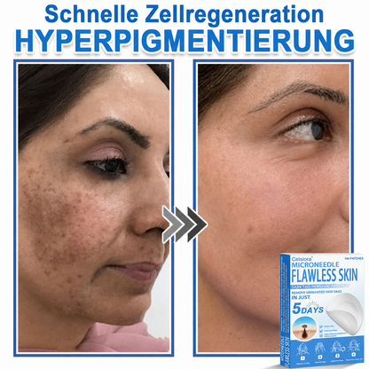 👩‍⚕️ Celsiora® 2-in-1 Mikronadel- & Hydrokolloid-Pflaster | Entferner für erhabene Muttermale, Akne, flache Warzen & Hautanhängsel | Verbessert Falten, Narben & Hautunreinheiten | Unsichtbare Stern-Pickelpflaster für Gesicht & Körper🌿