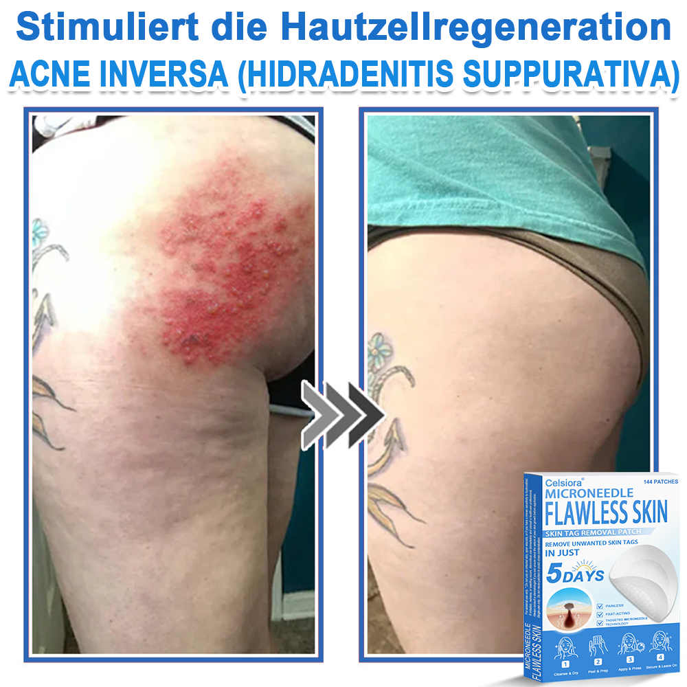 👩‍⚕️ Celsiora® 2-in-1 Mikronadel- & Hydrokolloid-Pflaster | Entferner für erhabene Muttermale, Akne, flache Warzen & Hautanhängsel | Verbessert Falten, Narben & Hautunreinheiten | Unsichtbare Stern-Pickelpflaster für Gesicht & Körper🌿